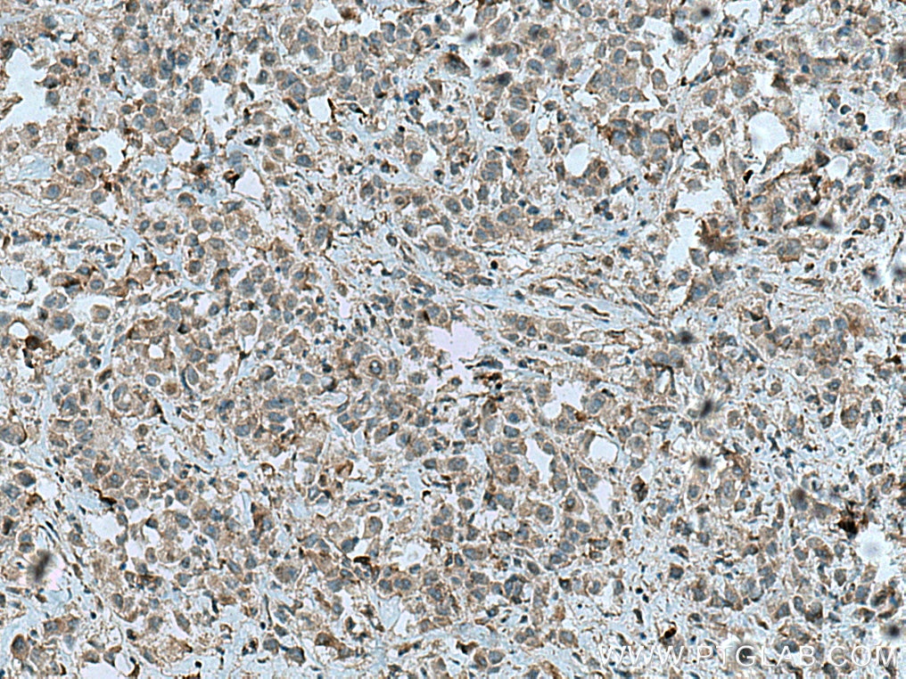 Immunohistochemistry (IHC) staining of human breast cancer tissue using PRKD3 Polyclonal antibody (12785-1-AP)