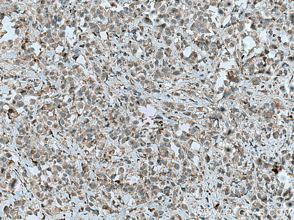 IHC staining of human breast cancer using 12785-1-AP