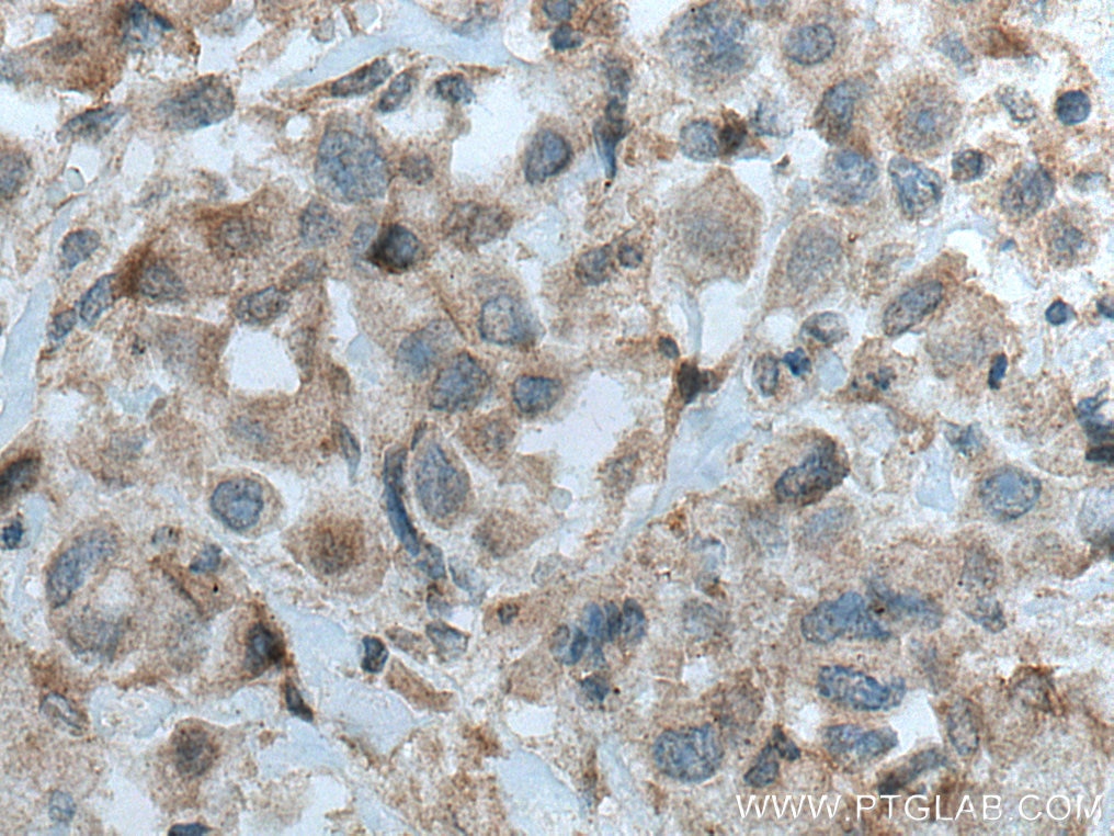 Immunohistochemistry (IHC) staining of human breast cancer tissue using PRKD3 Polyclonal antibody (12785-1-AP)