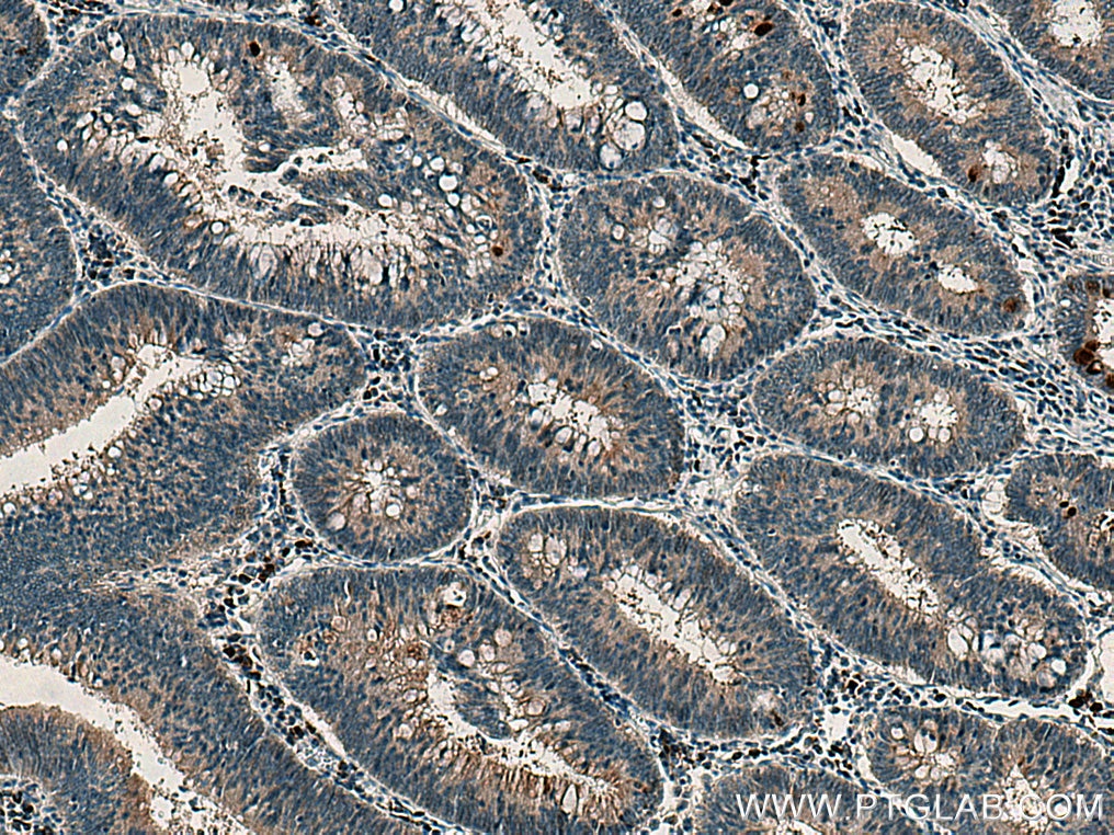 IHC staining of human colon cancer using 12785-1-AP