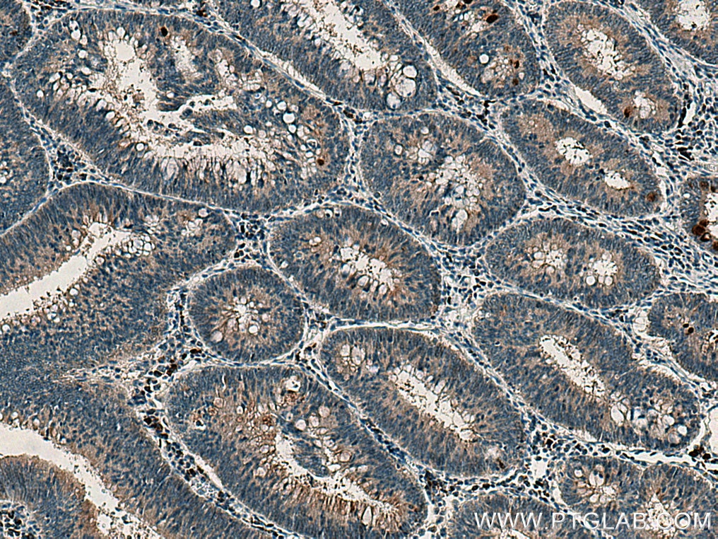 Immunohistochemistry (IHC) staining of human colon cancer tissue using PRKD3 Polyclonal antibody (12785-1-AP)