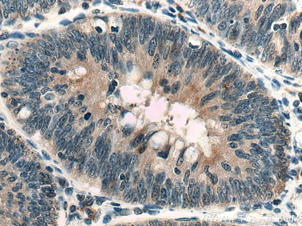 Immunohistochemistry (IHC) staining of human colon cancer tissue using PRKD3 Polyclonal antibody (12785-1-AP)