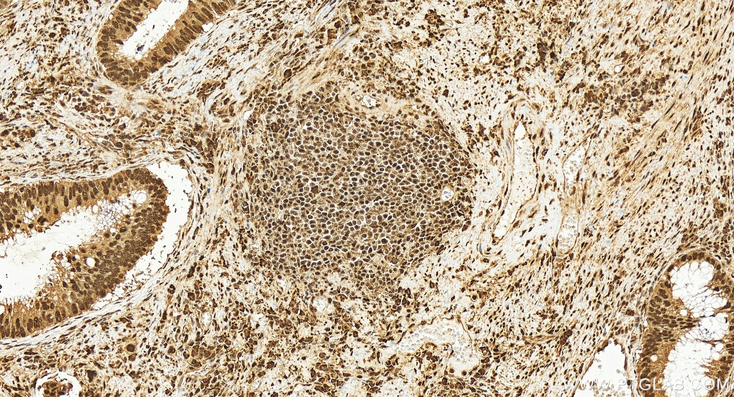 Immunohistochemistry (IHC) staining of human colon cancer tissue using DNA-PKcs Recombinant antibody (85370-2-RR)