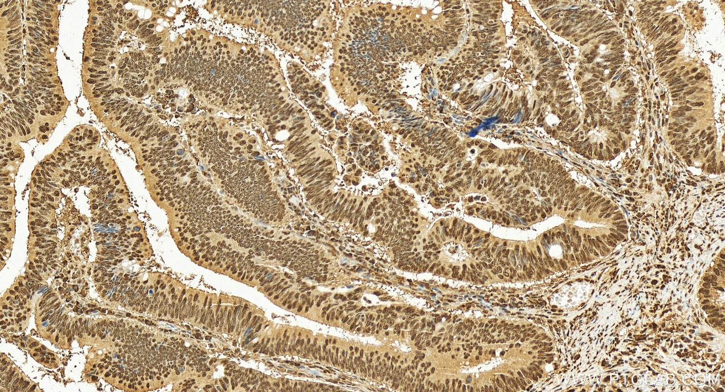 Immunohistochemistry (IHC) staining of human colon cancer tissue using DNA-PKcs Recombinant antibody (85370-2-RR)