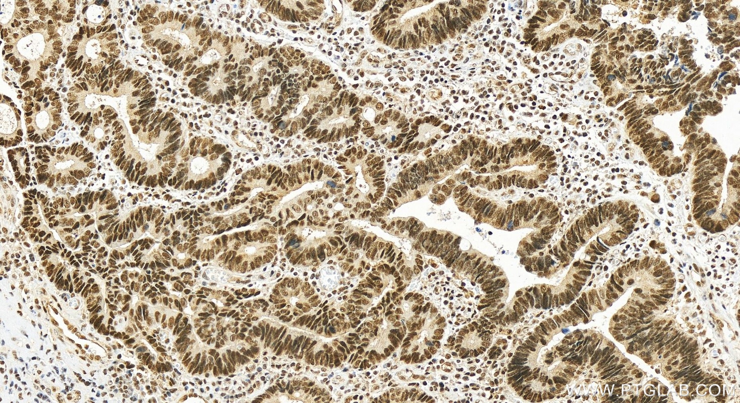 Immunohistochemistry (IHC) staining of human colon cancer tissue using PRKRIP1 Polyclonal antibody (16794-1-AP)
