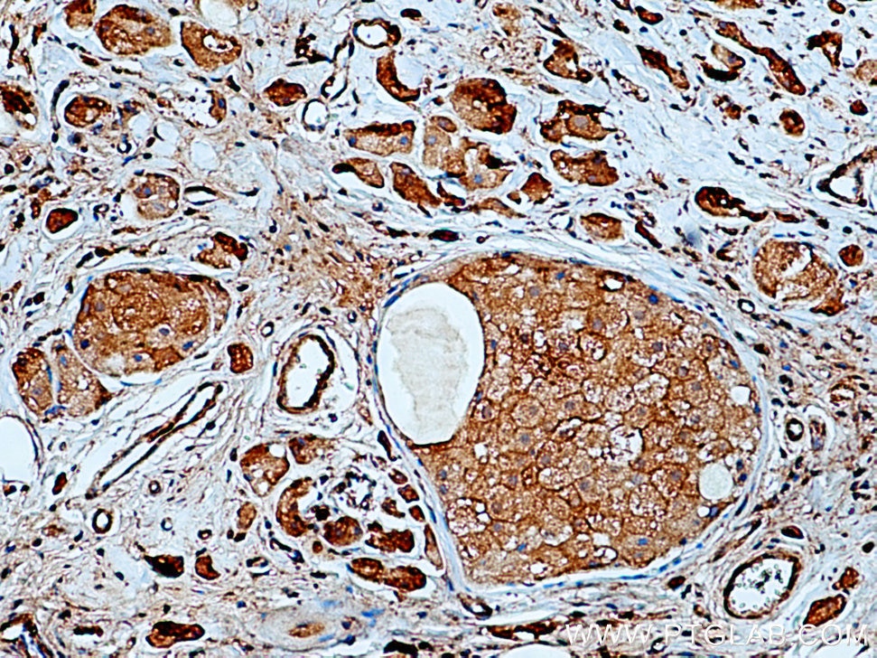 Immunohistochemistry (IHC) staining of human breast cancer tissue using PRLR Monoclonal antibody (67292-1-Ig)