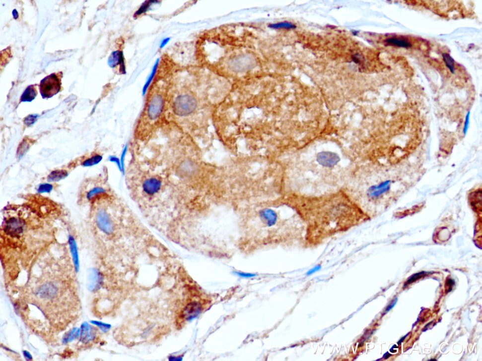Immunohistochemistry (IHC) staining of human breast cancer tissue using PRLR Monoclonal antibody (67292-1-Ig)
