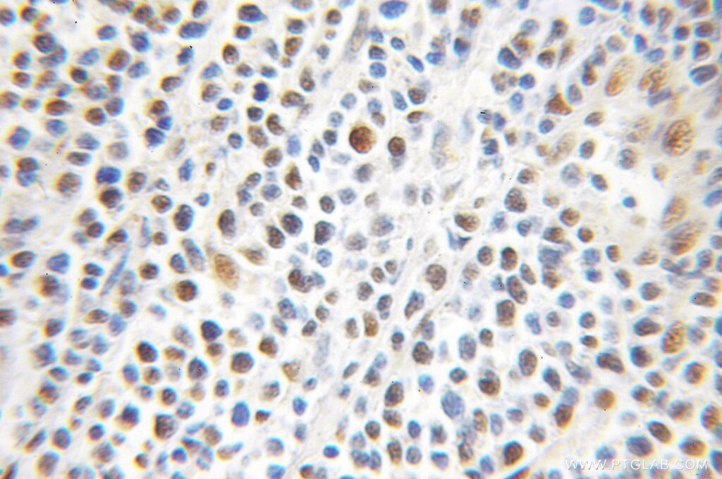 IHC staining of human lymphoma using 11279-1-AP