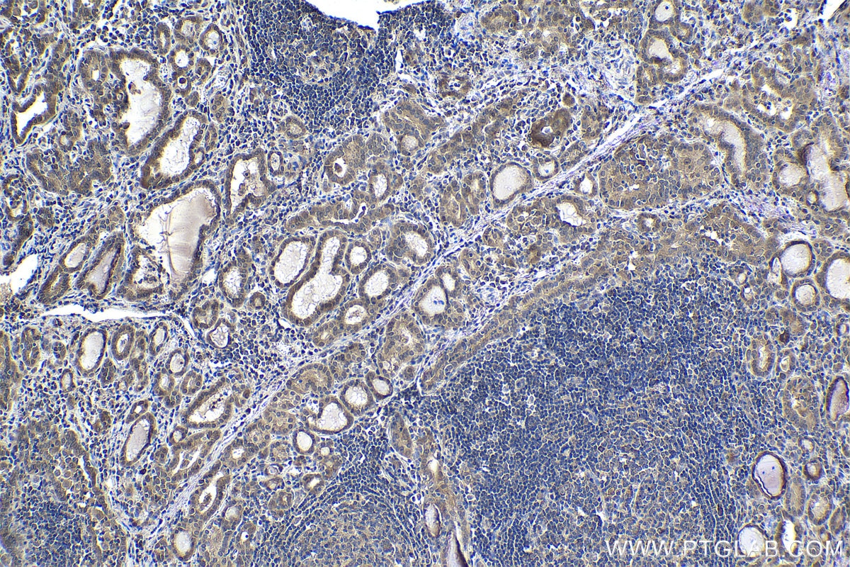 Immunohistochemistry (IHC) staining of human thyroid cancer tissue using PRMT2 Monoclonal antibody (66885-1-Ig)