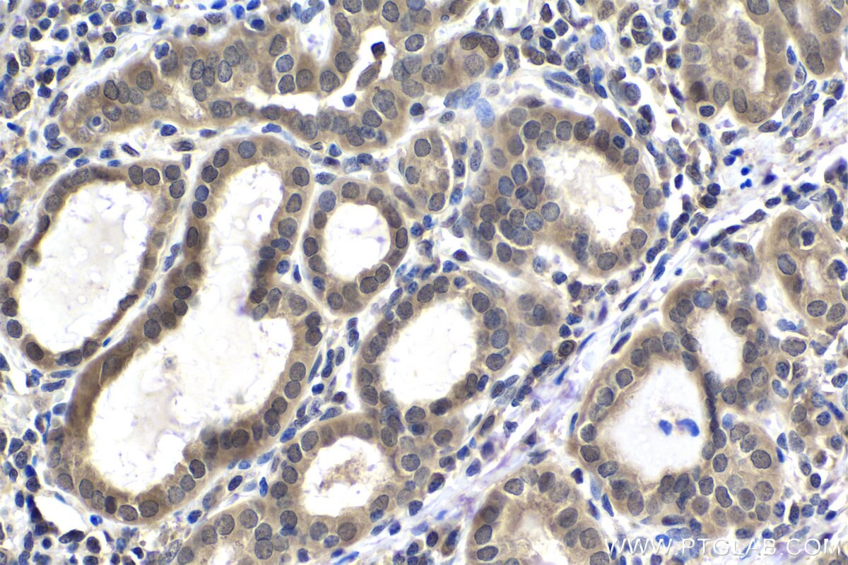 Immunohistochemistry (IHC) staining of human thyroid cancer tissue using PRMT2 Monoclonal antibody (66885-1-Ig)