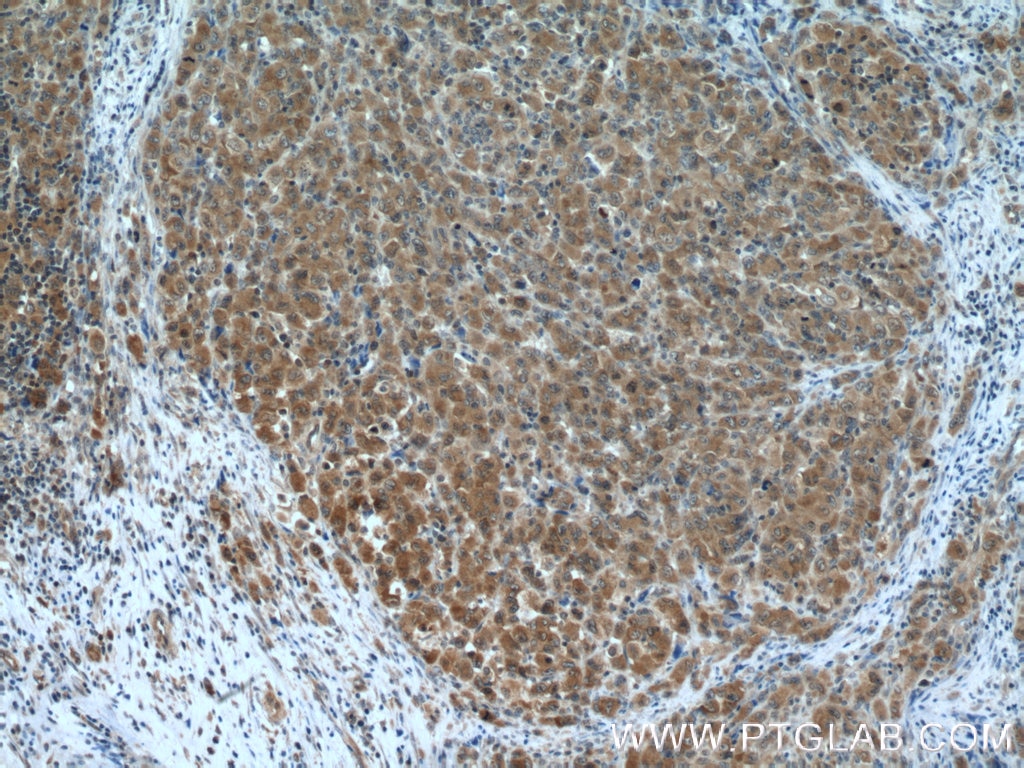 Immunohistochemistry (IHC) staining of human lymphoma tissue using PRMT5 Polyclonal antibody (18436-1-AP)