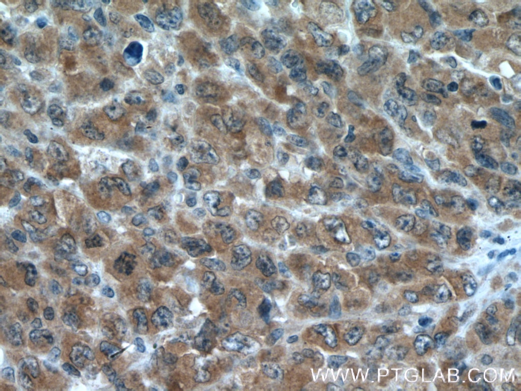 Immunohistochemistry (IHC) staining of human lymphoma tissue using PRMT5 Polyclonal antibody (18436-1-AP)