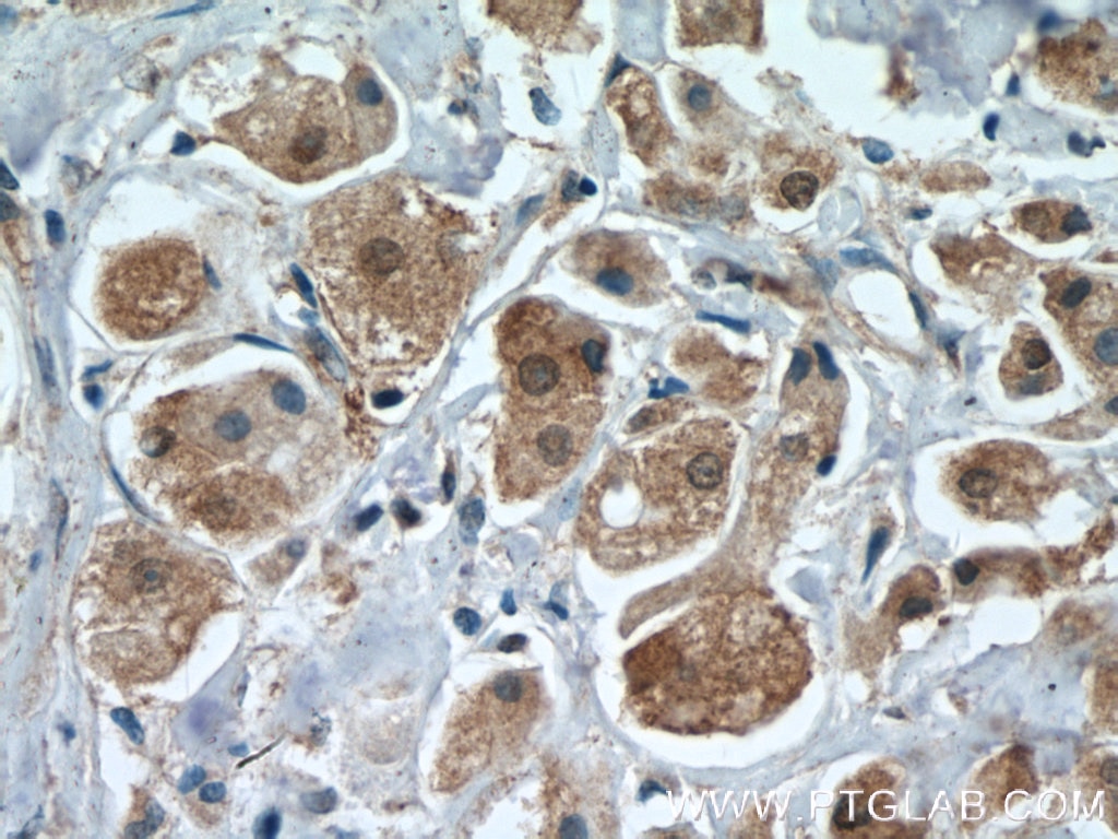 Immunohistochemistry (IHC) staining of human breast cancer tissue using PRMT5 Polyclonal antibody (18436-1-AP)