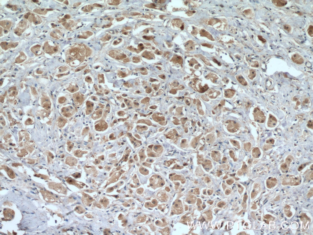 Immunohistochemistry (IHC) staining of human breast cancer tissue using PRMT5 Polyclonal antibody (18436-1-AP)
