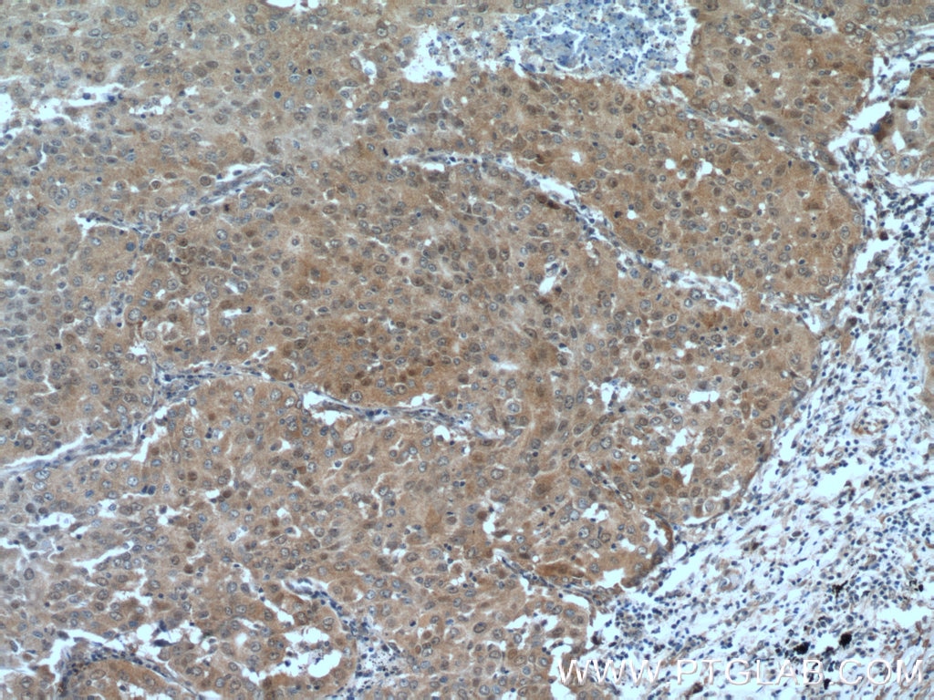 Immunohistochemistry (IHC) staining of human lung cancer tissue using PRMT5 Polyclonal antibody (18436-1-AP)