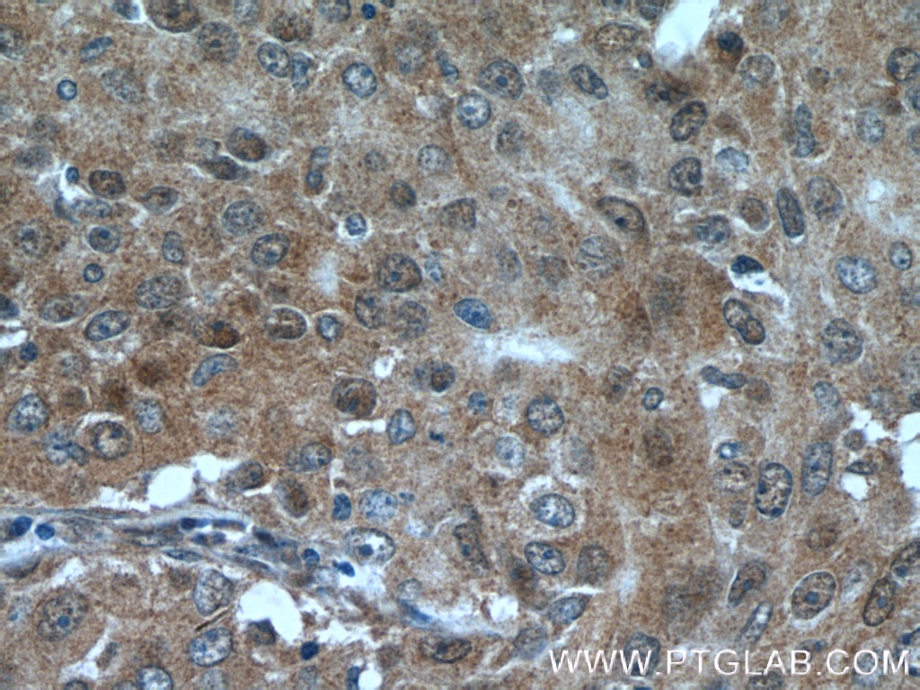 Immunohistochemistry (IHC) staining of human lung cancer tissue using PRMT5 Polyclonal antibody (18436-1-AP)