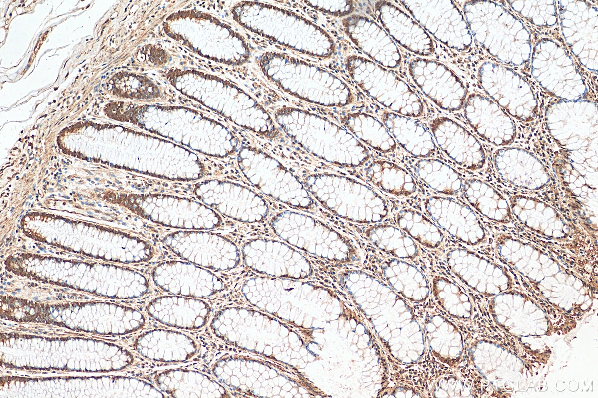 Immunohistochemistry (IHC) staining of human colon cancer tissue using PRMT5 Polyclonal antibody (18436-1-AP)