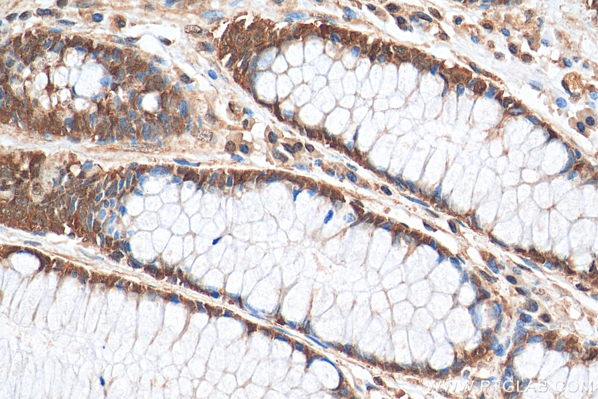 Immunohistochemistry (IHC) staining of human colon cancer tissue using PRMT5 Polyclonal antibody (18436-1-AP)