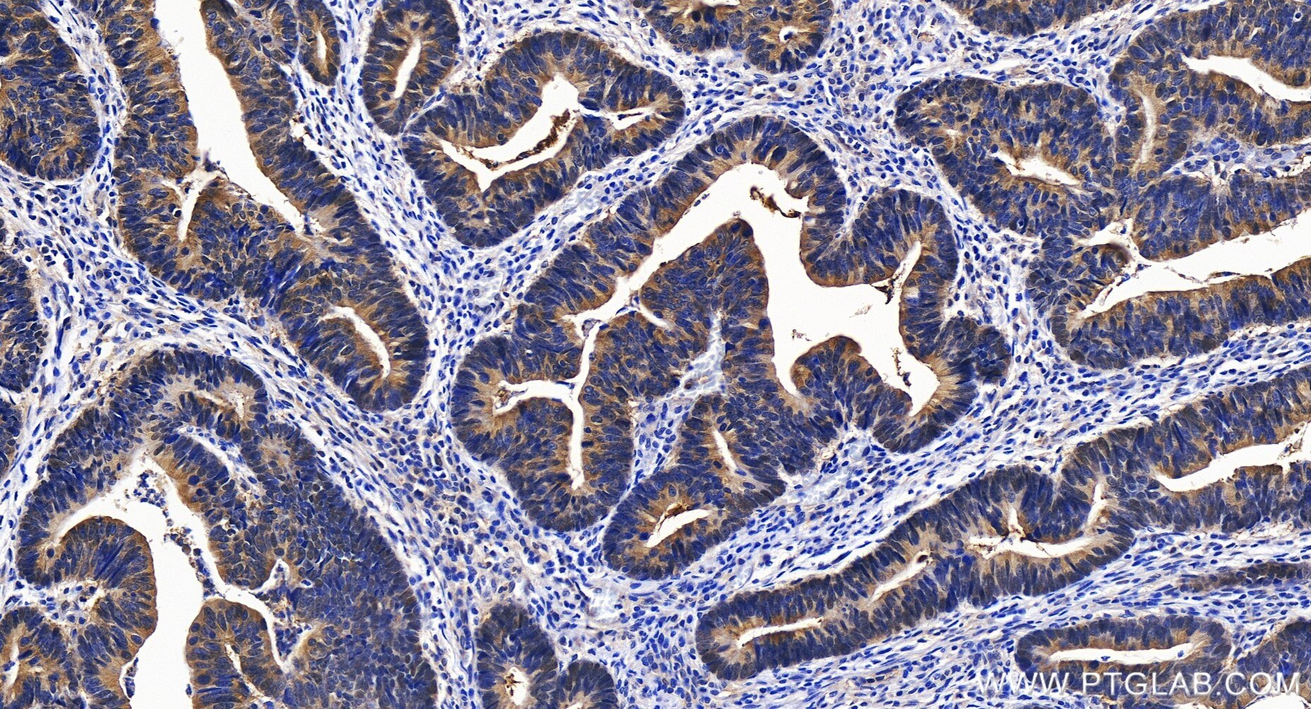 Immunohistochemistry (IHC) staining of human colon cancer tissue using PRMT5 Recombinant antibody (82750-2-RR)