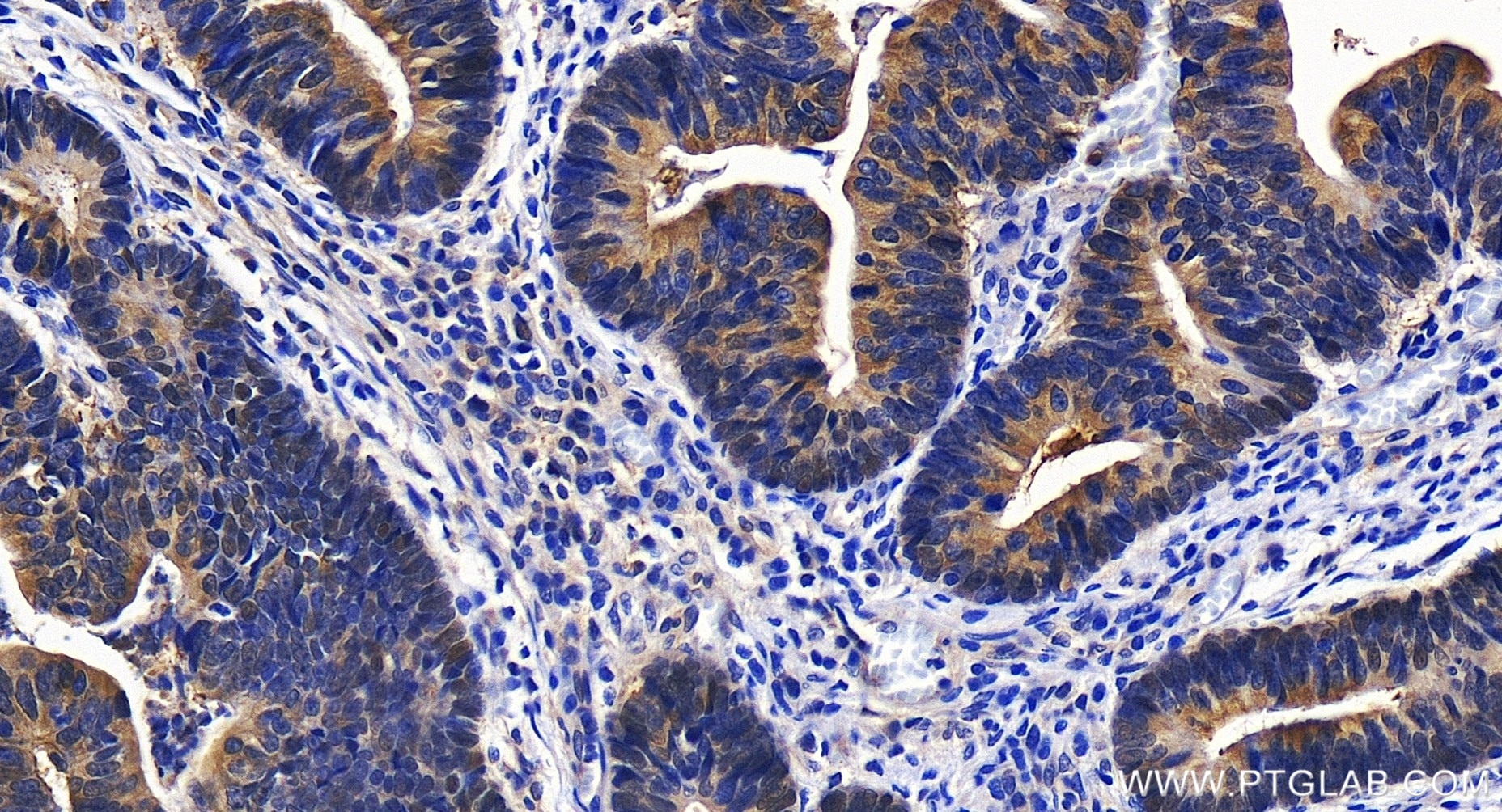 Immunohistochemistry (IHC) staining of human colon cancer tissue using PRMT5 Recombinant antibody (82750-2-RR)
