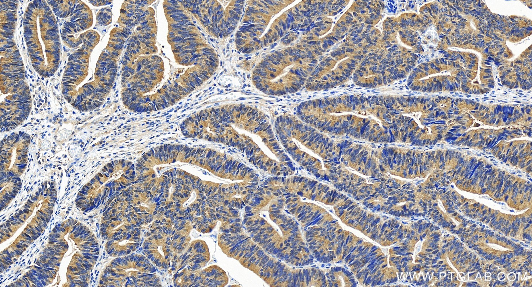 Immunohistochemical analysis of paraffin-embedded human colon cancer tissue slide using 82750-3-RR (PRMT5 antibody) at dilution of 1:400 (under 20x lens). Heat mediated antigen retrieval with Tris-EDTA buffer (pH 9.0). Immunohistochemistry (IHC) staining of human colon cancer tissue using PRMT5 Recombinant antibody (82750-3-RR)