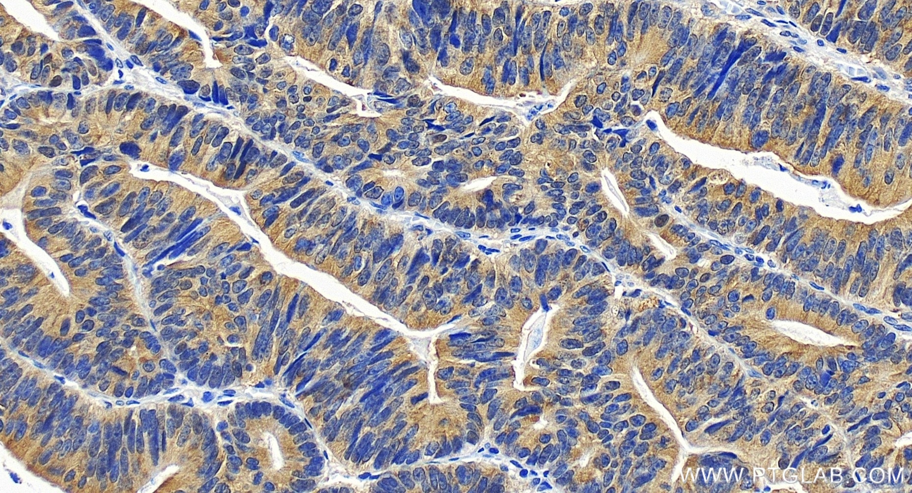 Immunohistochemical analysis of paraffin-embedded human colon cancer tissue slide using 82750-3-RR (PRMT5 antibody) at dilution of 1:400 (under 20x lens). Heat mediated antigen retrieval with Tris-EDTA buffer (pH 9.0). Immunohistochemistry (IHC) staining of human colon cancer tissue using PRMT5 Recombinant antibody (82750-3-RR)