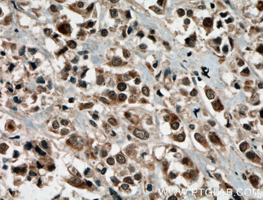 Immunohistochemistry (IHC) staining of human breast cancer tissue using PRMT6 Polyclonal antibody (15395-1-AP)