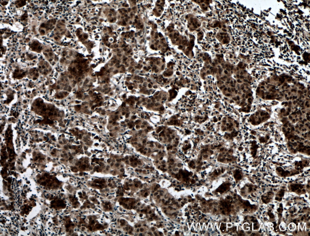 Immunohistochemistry (IHC) staining of human prostate cancer tissue using PRMT6 Polyclonal antibody (15395-1-AP)