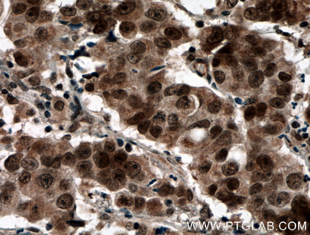 Immunohistochemistry (IHC) staining of human prostate cancer tissue using PRMT6 Polyclonal antibody (15395-1-AP)