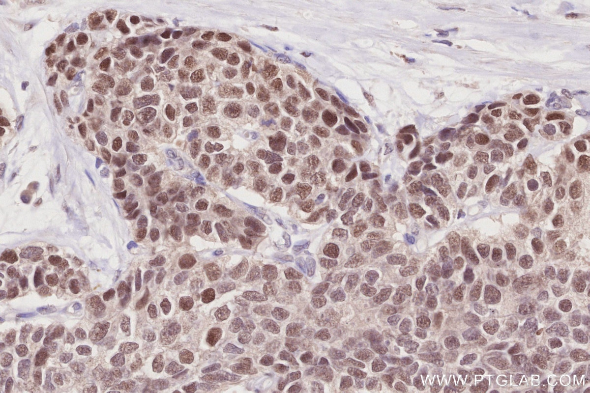Immunohistochemistry (IHC) staining of human stomach cancer tissue using PRMT6 Polyclonal antibody (15395-1-AP)