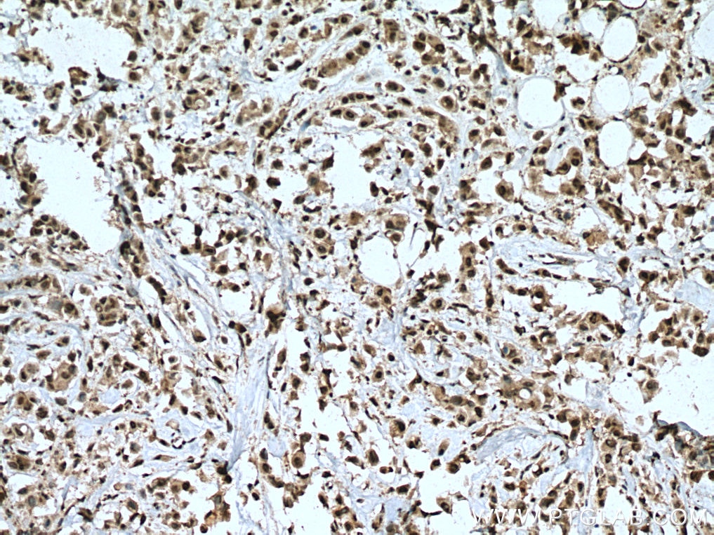 Immunohistochemistry (IHC) staining of human breast cancer tissue using PRMT8 Polyclonal antibody (12557-1-AP)
