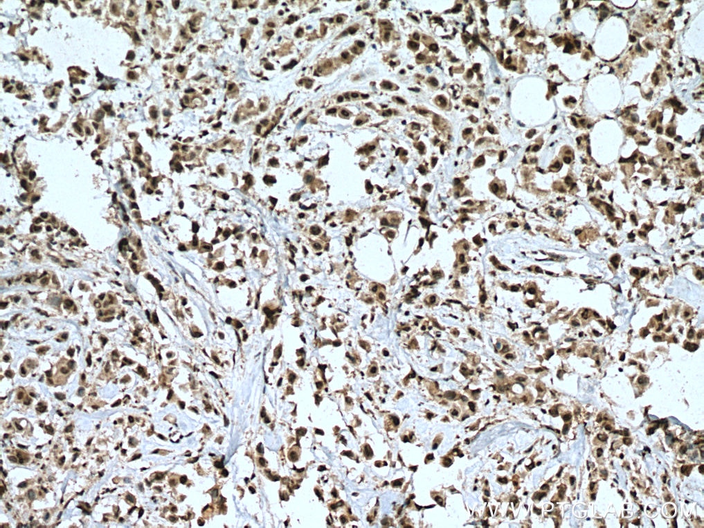 Immunohistochemistry (IHC) staining of human breast cancer tissue using PRMT8 Polyclonal antibody (12557-1-AP)