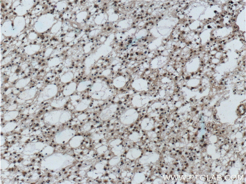 IHC staining of human gliomas using 12555-1-AP