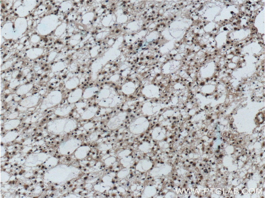 Immunohistochemistry (IHC) staining of human gliomas tissue using PrP Polyclonal antibody (12555-1-AP)