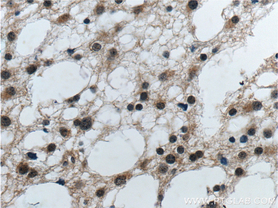 Immunohistochemistry (IHC) staining of human gliomas tissue using PrP Polyclonal antibody (12555-1-AP)