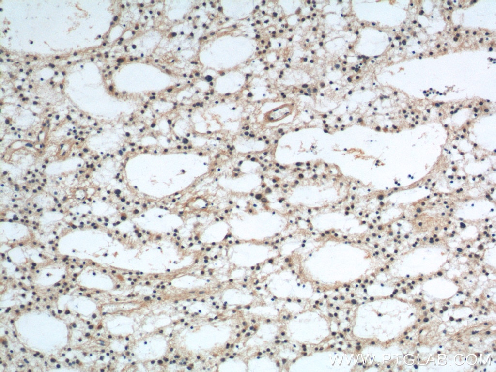 Immunohistochemistry (IHC) staining of human gliomas tissue using PrP Polyclonal antibody (12555-1-AP)