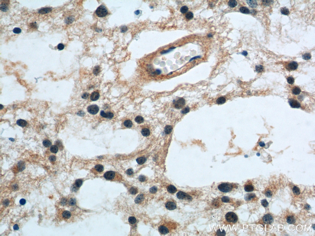 IHC staining of human gliomas using 12555-1-AP