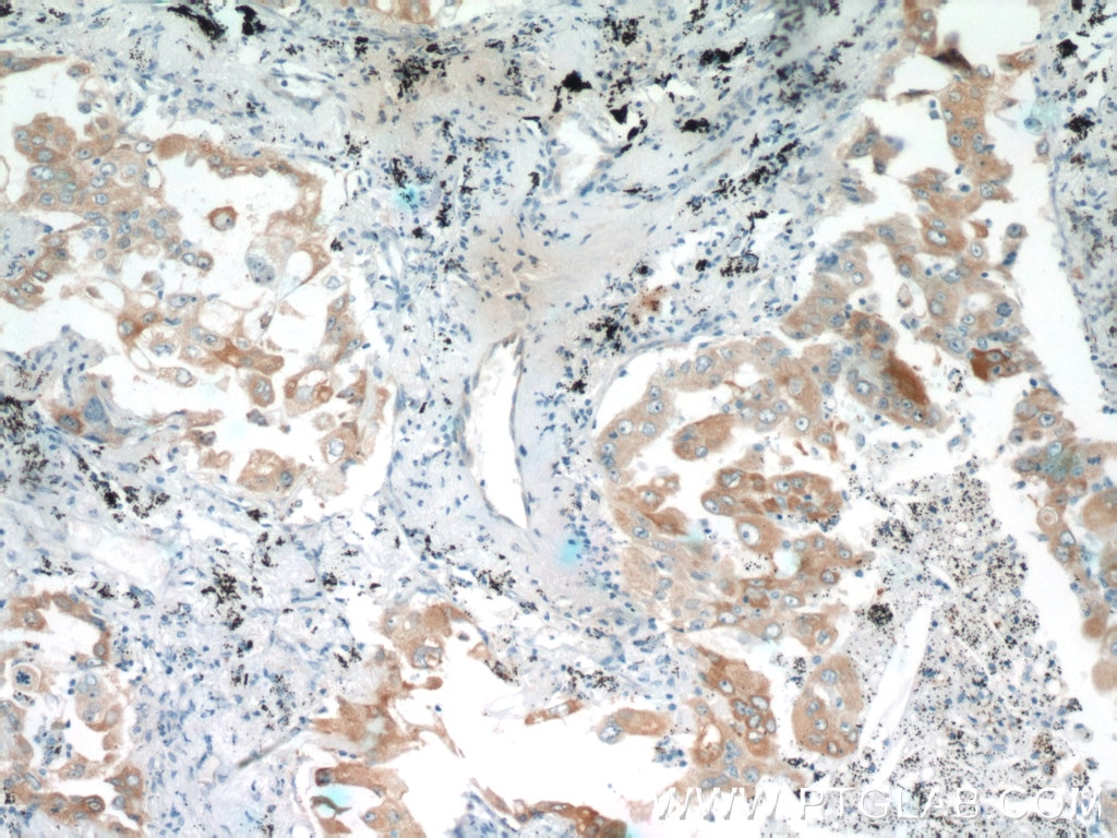 Immunohistochemistry (IHC) staining of human lung cancer tissue using PROCR Polyclonal antibody (11391-1-AP)