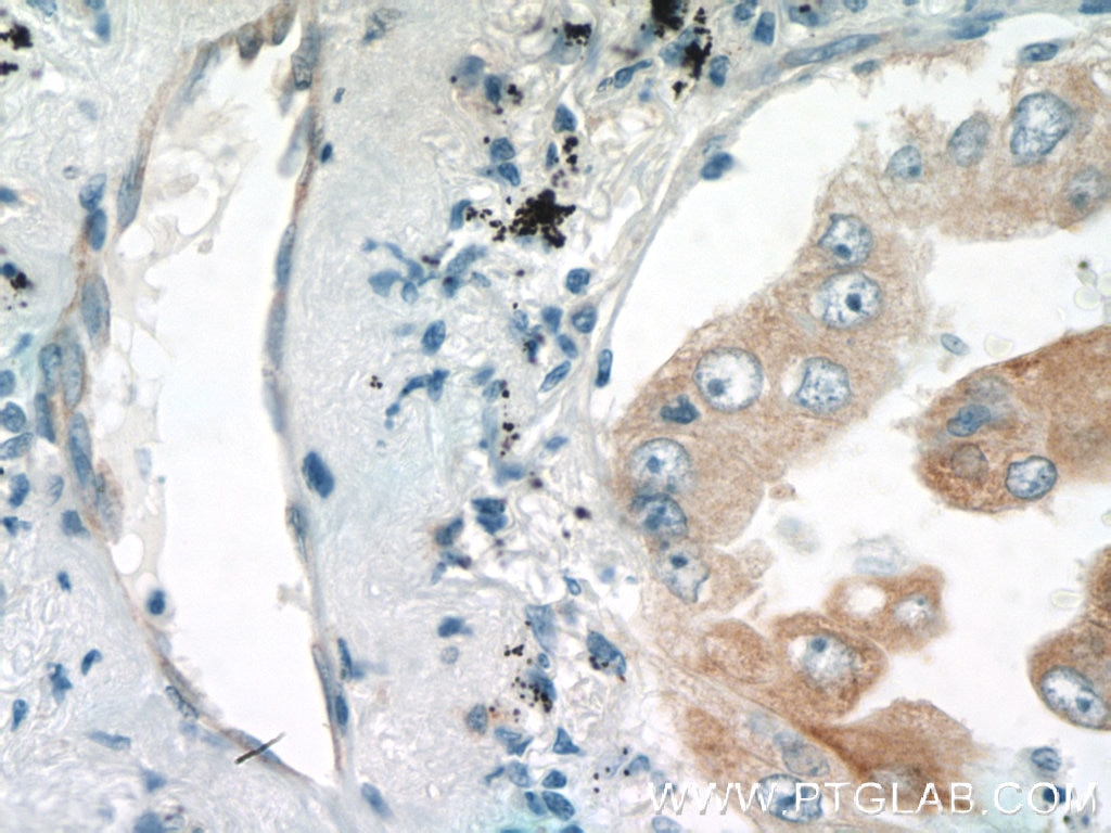 Immunohistochemistry (IHC) staining of human lung cancer tissue using PROCR Polyclonal antibody (11391-1-AP)