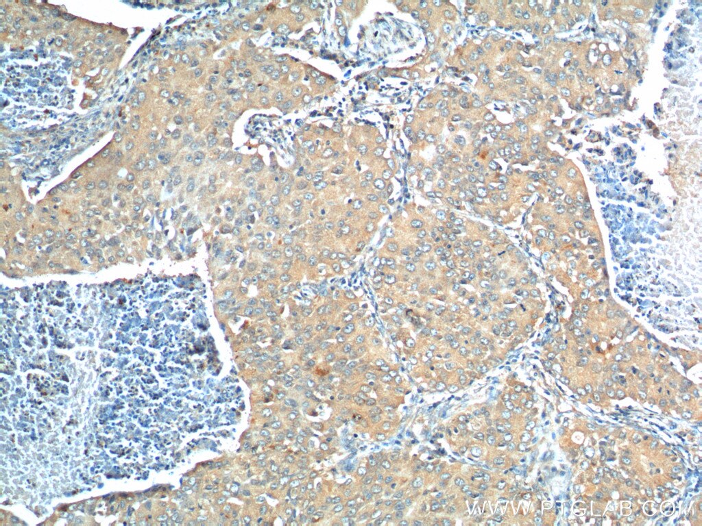 Immunohistochemistry (IHC) staining of human lung cancer tissue using PROCR Polyclonal antibody (11391-1-AP)