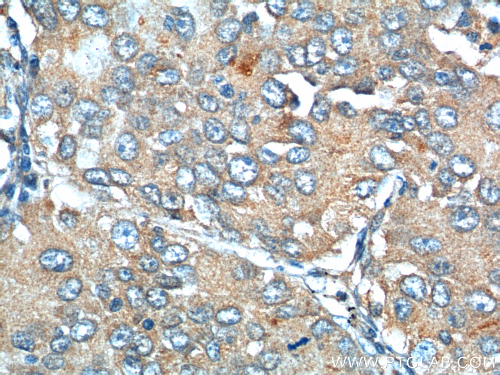 Immunohistochemistry (IHC) staining of human lung cancer tissue using PROCR Polyclonal antibody (11391-1-AP)