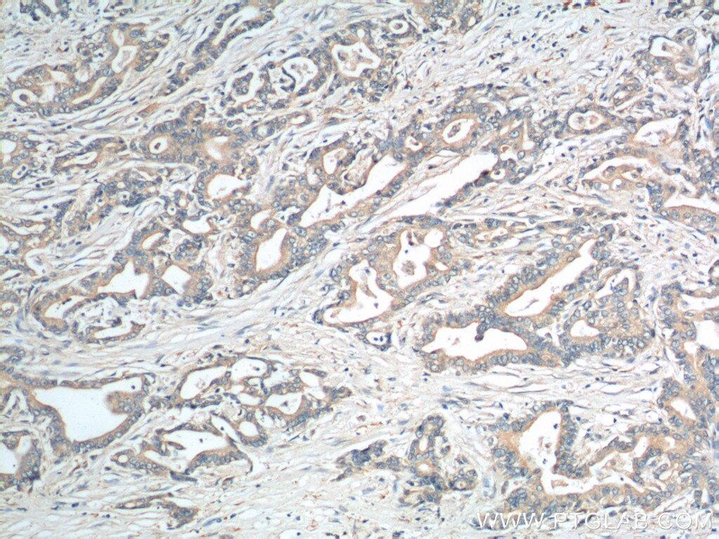Immunohistochemistry (IHC) staining of human pancreas cancer tissue using EPCR/CD201 Polyclonal antibody (11391-1-AP)