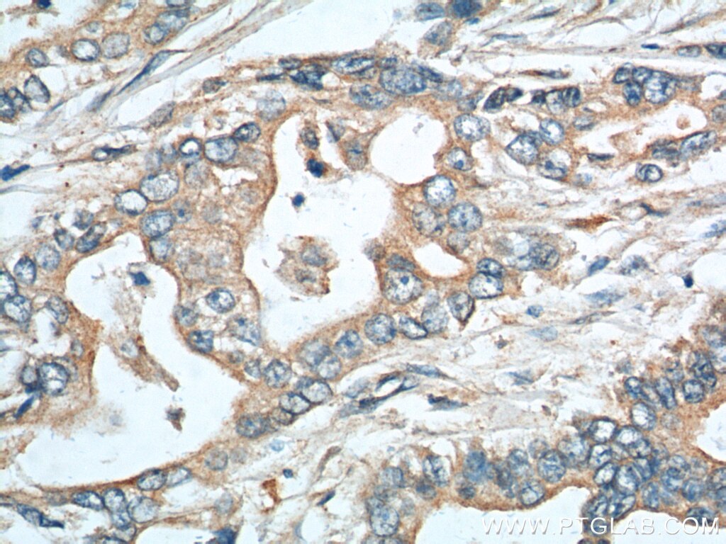 Immunohistochemistry (IHC) staining of human pancreas cancer tissue using EPCR/CD201 Polyclonal antibody (11391-1-AP)
