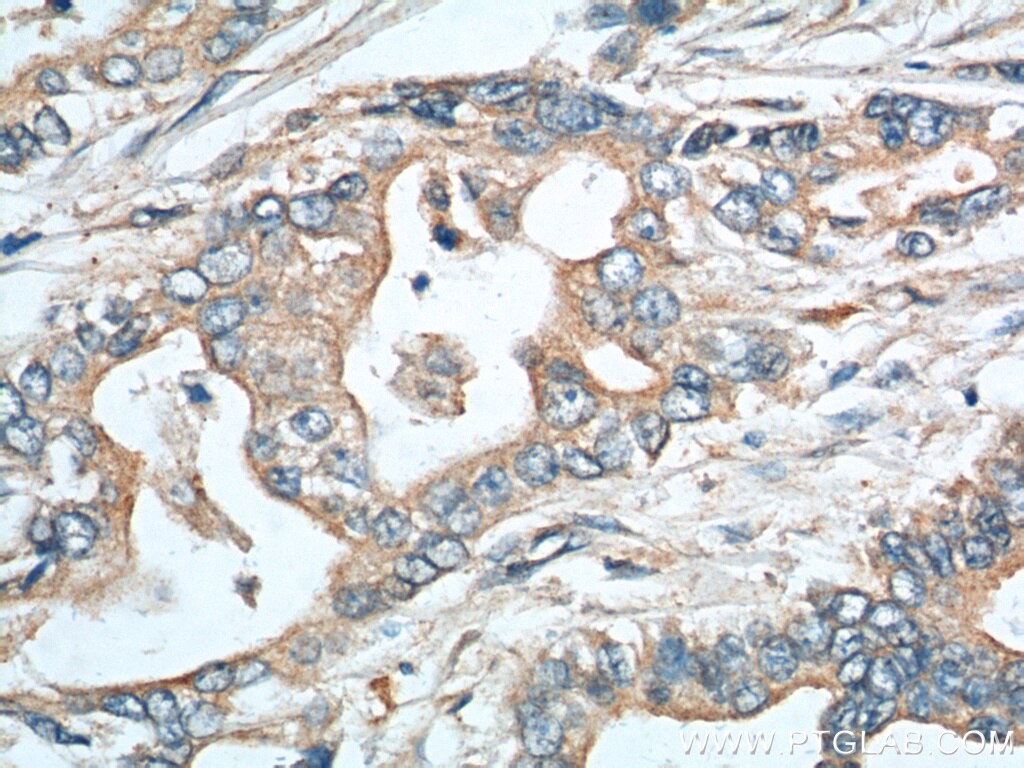 IHC staining of human pancreas cancer using 11391-1-AP