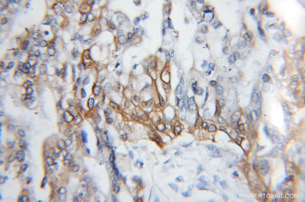 Immunohistochemistry (IHC) staining of human pancreas cancer tissue using PROCR Polyclonal antibody (11391-1-AP)