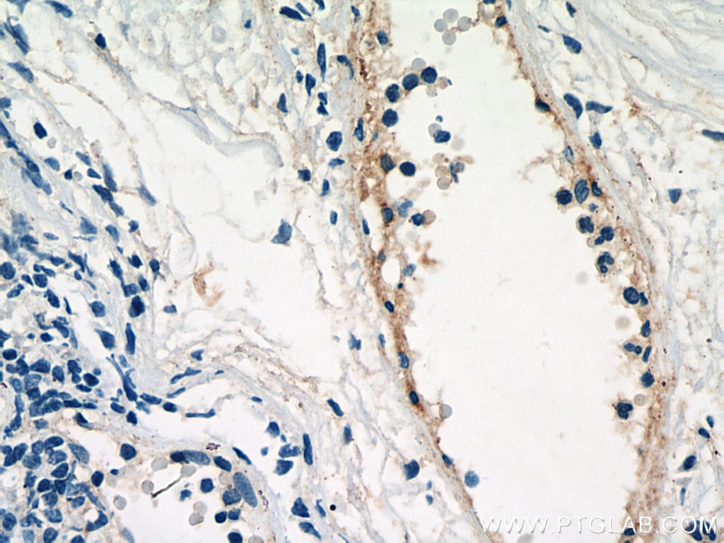 Immunohistochemistry (IHC) staining of human tonsillitis tissue using PROCR Monoclonal antibody (67658-1-Ig)