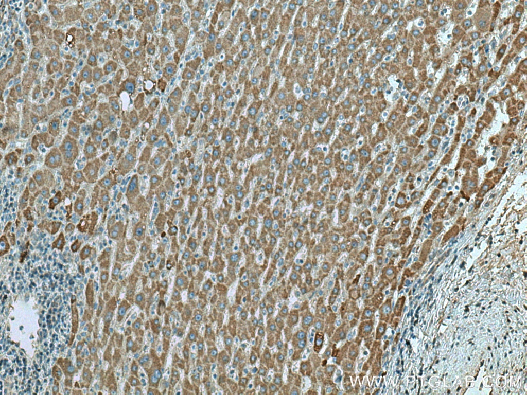 Immunohistochemistry (IHC) staining of human liver cancer tissue using PRODH Polyclonal antibody (22980-1-AP)