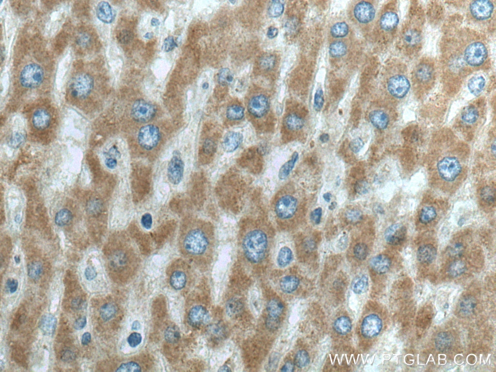 Immunohistochemistry (IHC) staining of human liver cancer tissue using PRODH Polyclonal antibody (22980-1-AP)