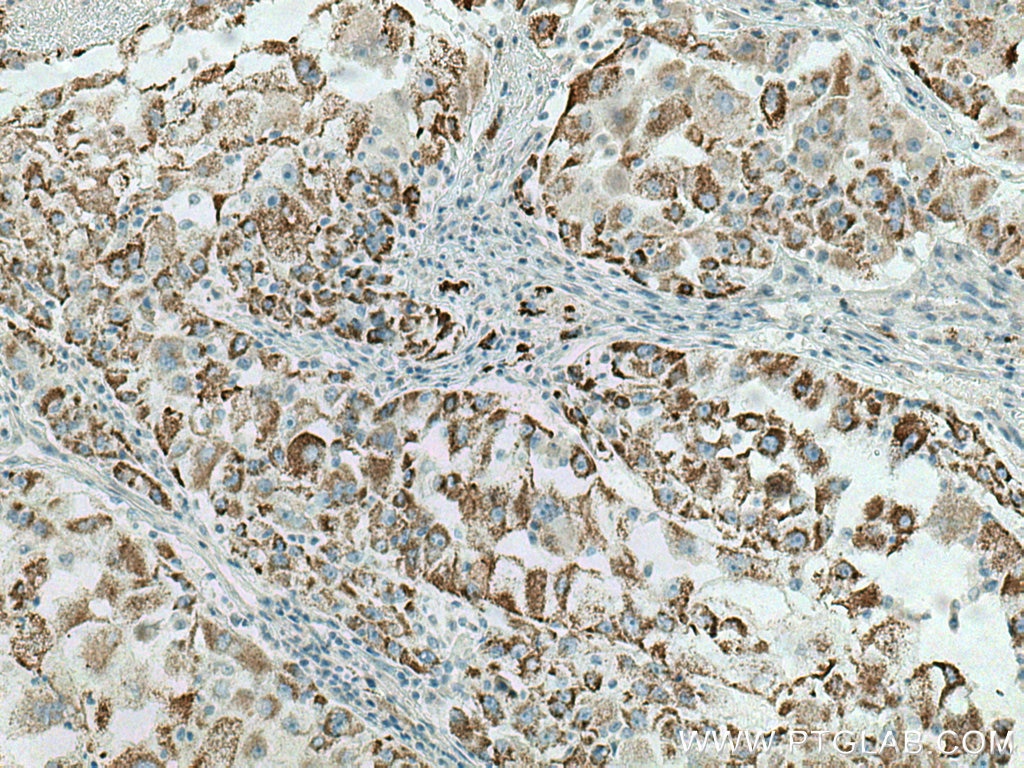 Immunohistochemistry (IHC) staining of human liver cancer tissue using PRODH Polyclonal antibody (22980-1-AP)