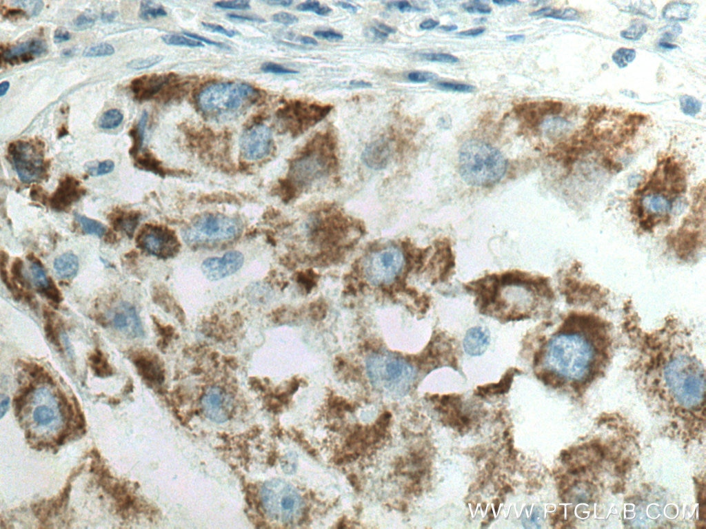 Immunohistochemistry (IHC) staining of human liver cancer tissue using PRODH Polyclonal antibody (22980-1-AP)